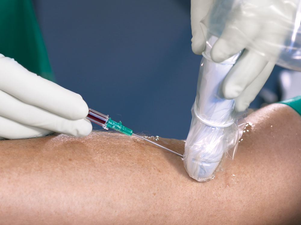 anesthesiologist using ultrasound visualization to place a peripheral iv catheter